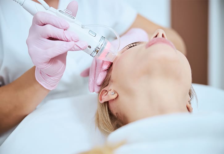 Radio-Frequency Microneedling -Face