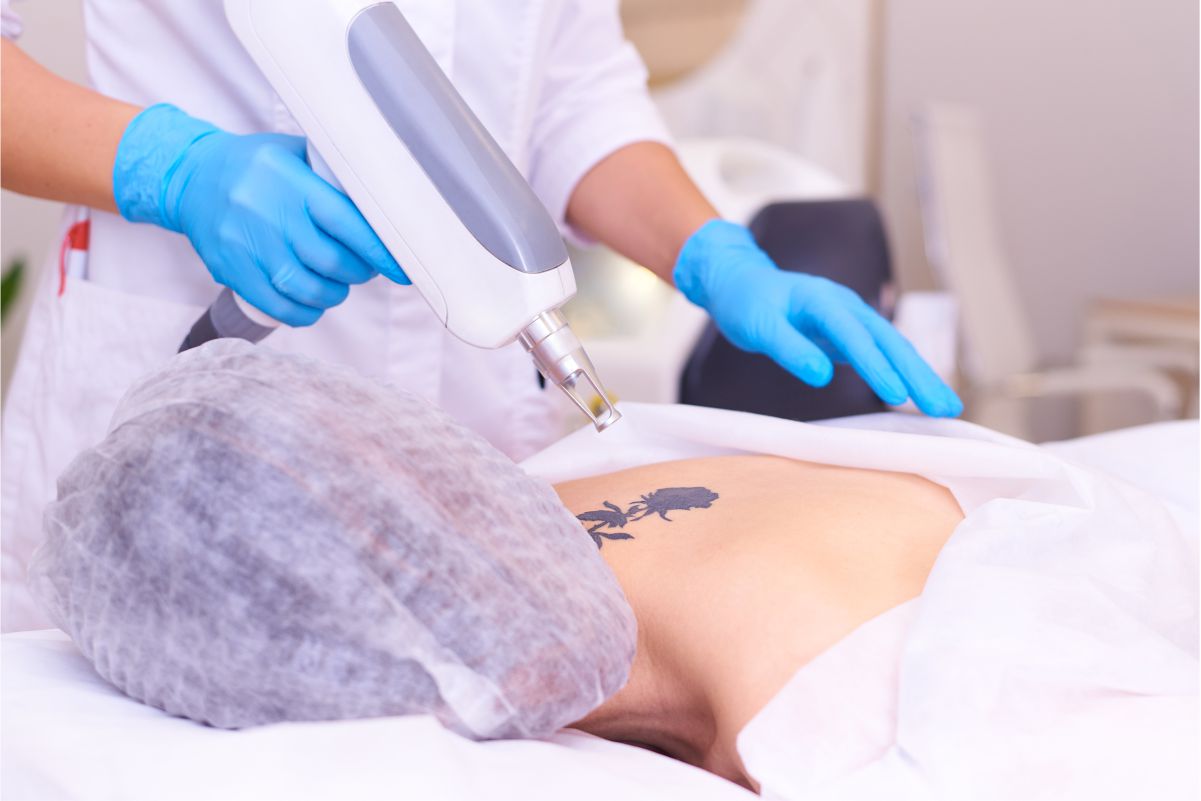 Tattoo Removal-Small Size