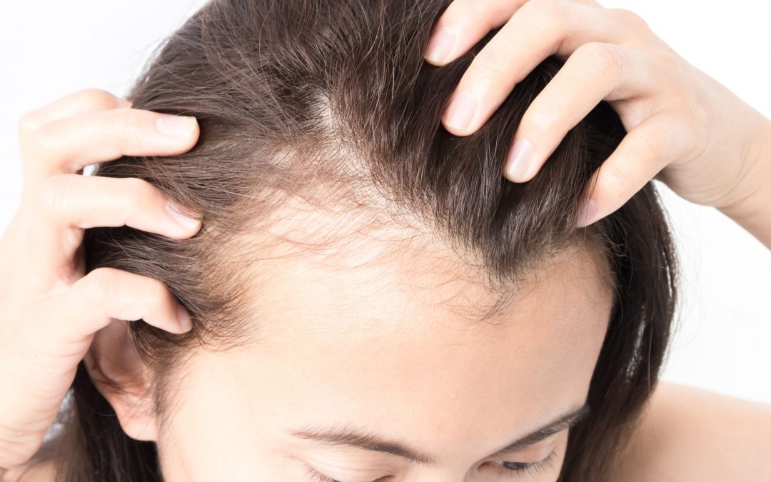 Mesotherapy for hair loss