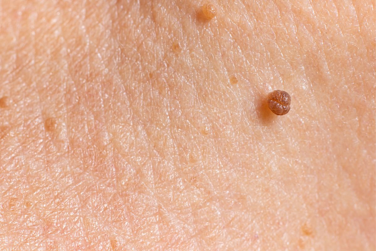 Small Skin Tag