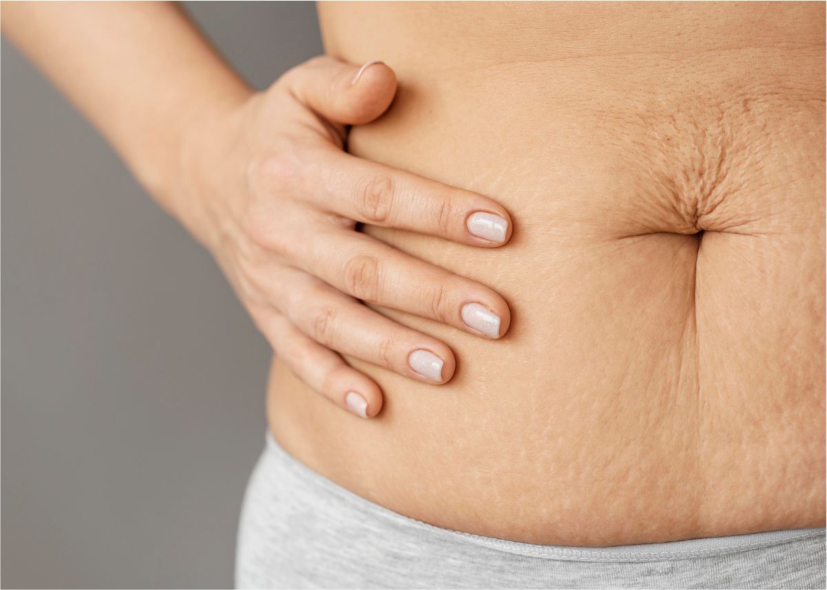 Co2 Laser Resurfacing For Stretch Marks