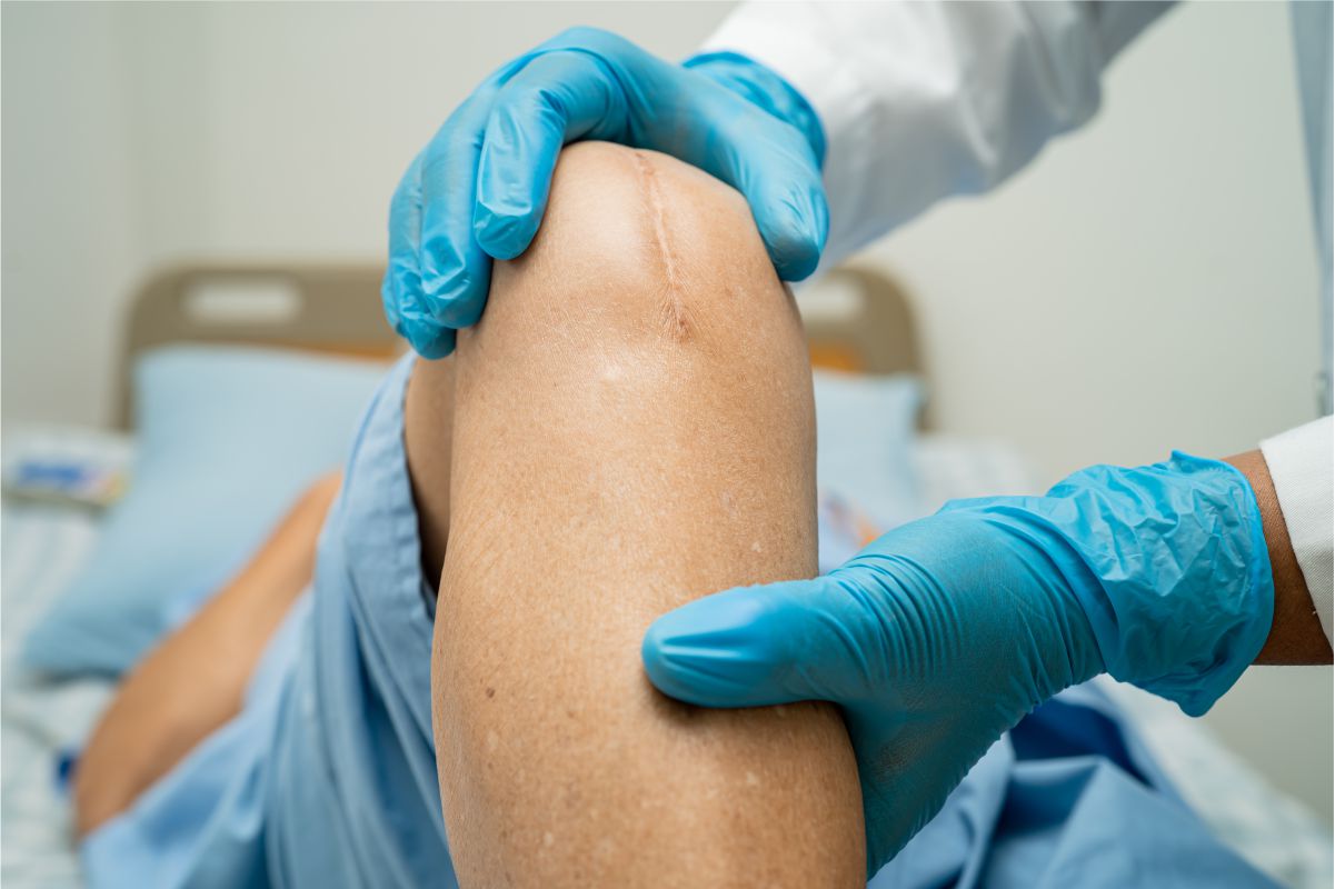 Microneedling For Scars