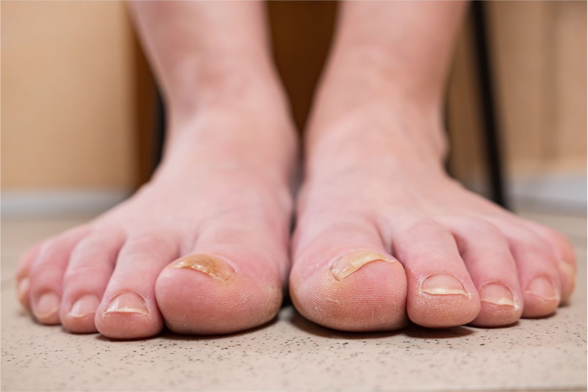 Nail Fungus Laser Treatment-For 10 Nails