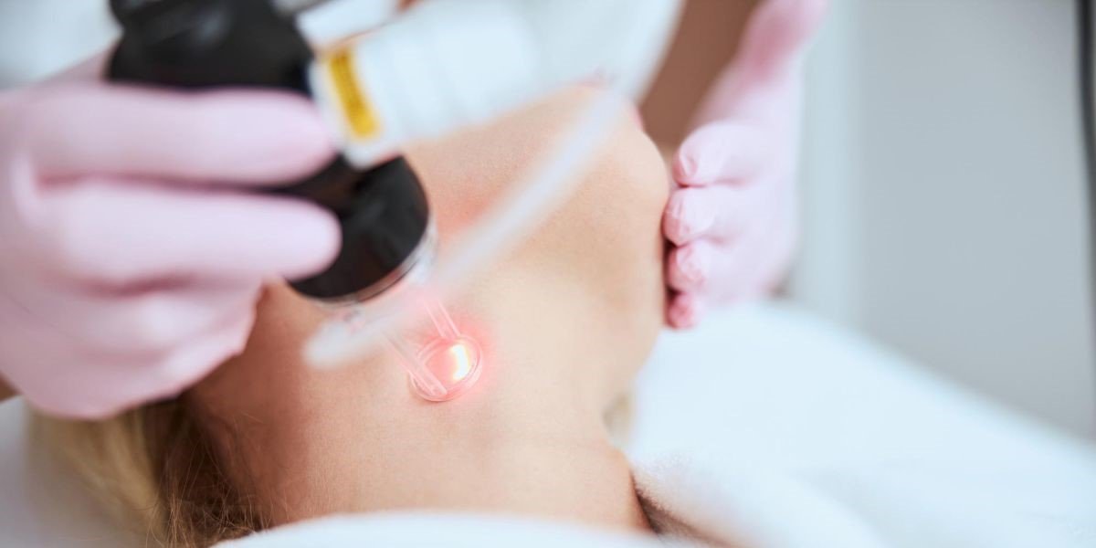 Co2 Laser Resurfacing For Neck