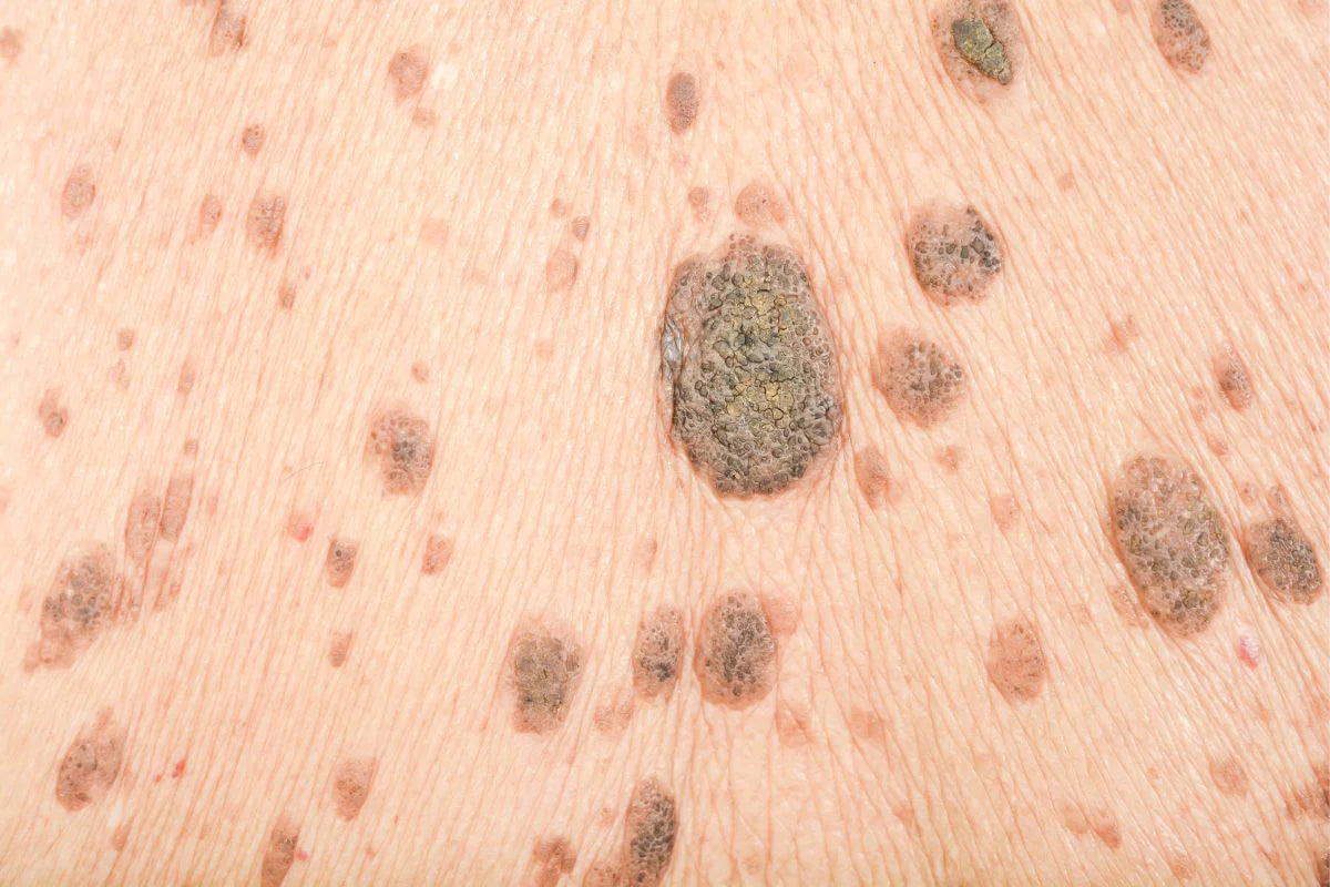 Unveiling the Mystery: What Causes Skin Tags and How to Prevent Them?