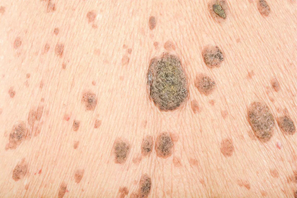 Skin Tags: Causes, Treatment Options and Cost in South Africa