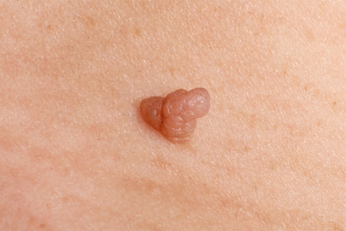 Skin Tags Removal