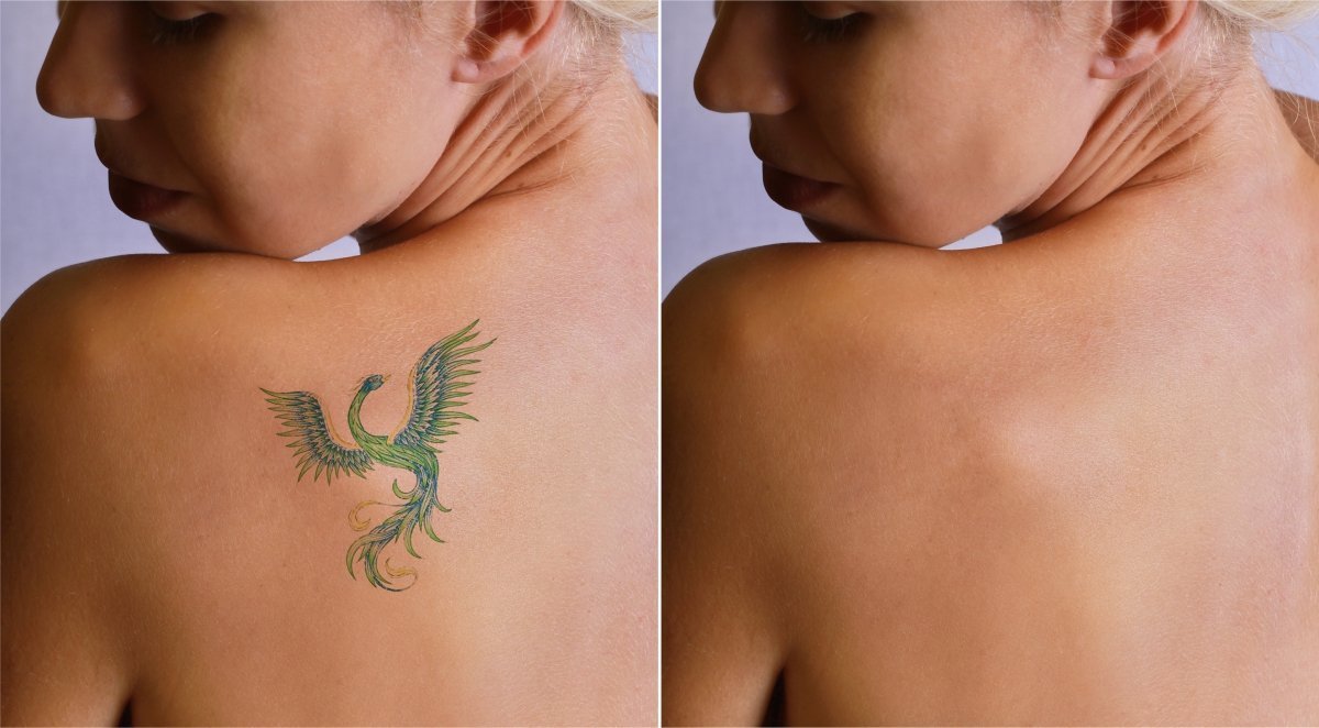 laser tattoo removal