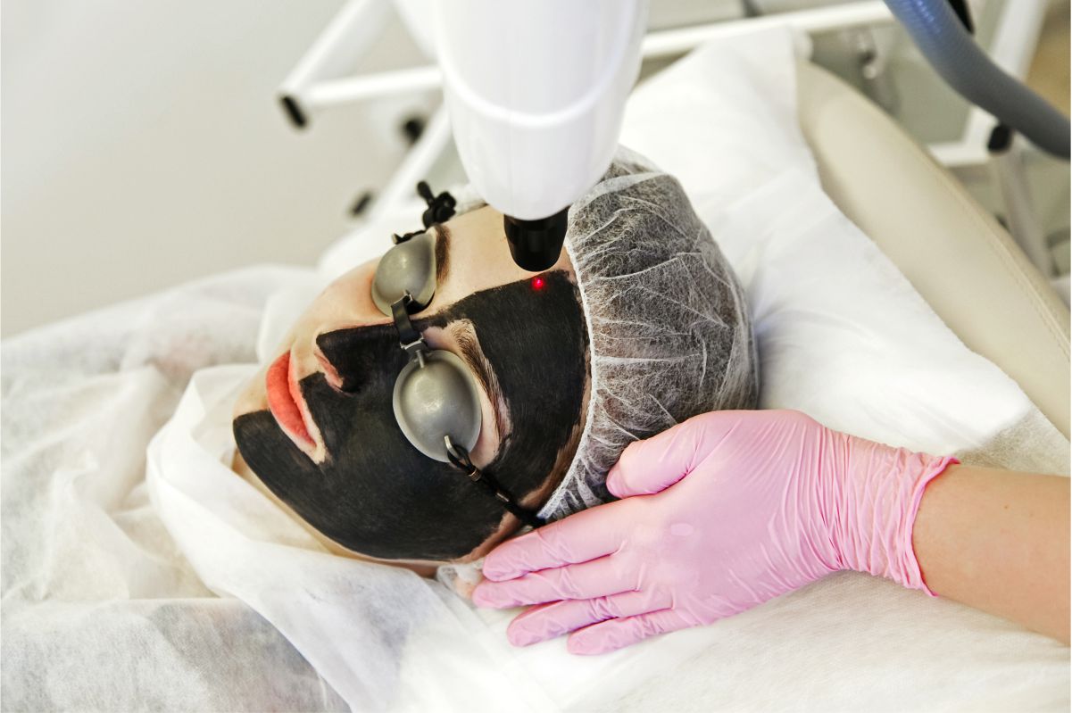 CARBON LASER PEEL FOR FACE - SPECIAL