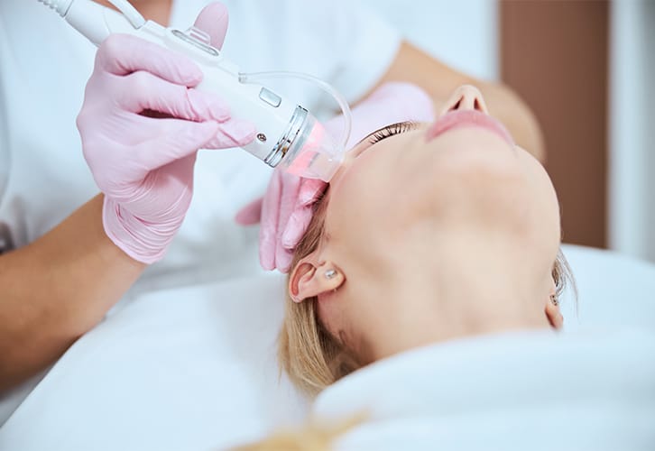 Fadio-Frequency Microneedling -Face
