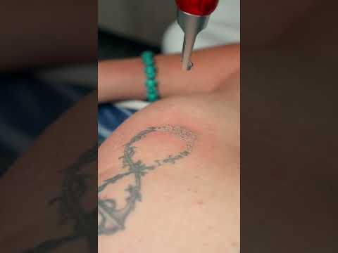 Tattoo Removal service at Skin Reform