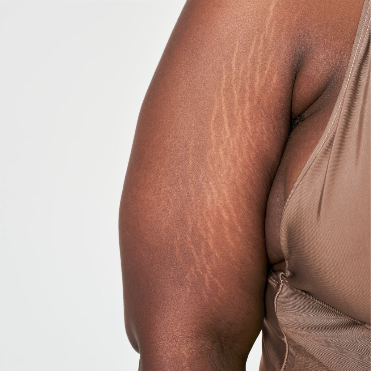 Microneedling For Stretch Marks
