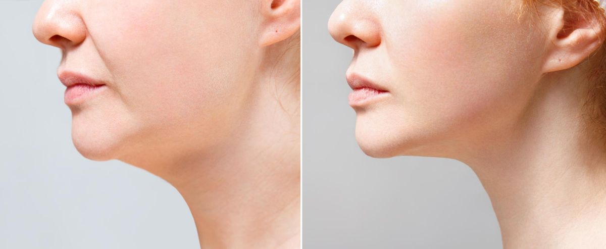 Fat Reduction - Chin Area