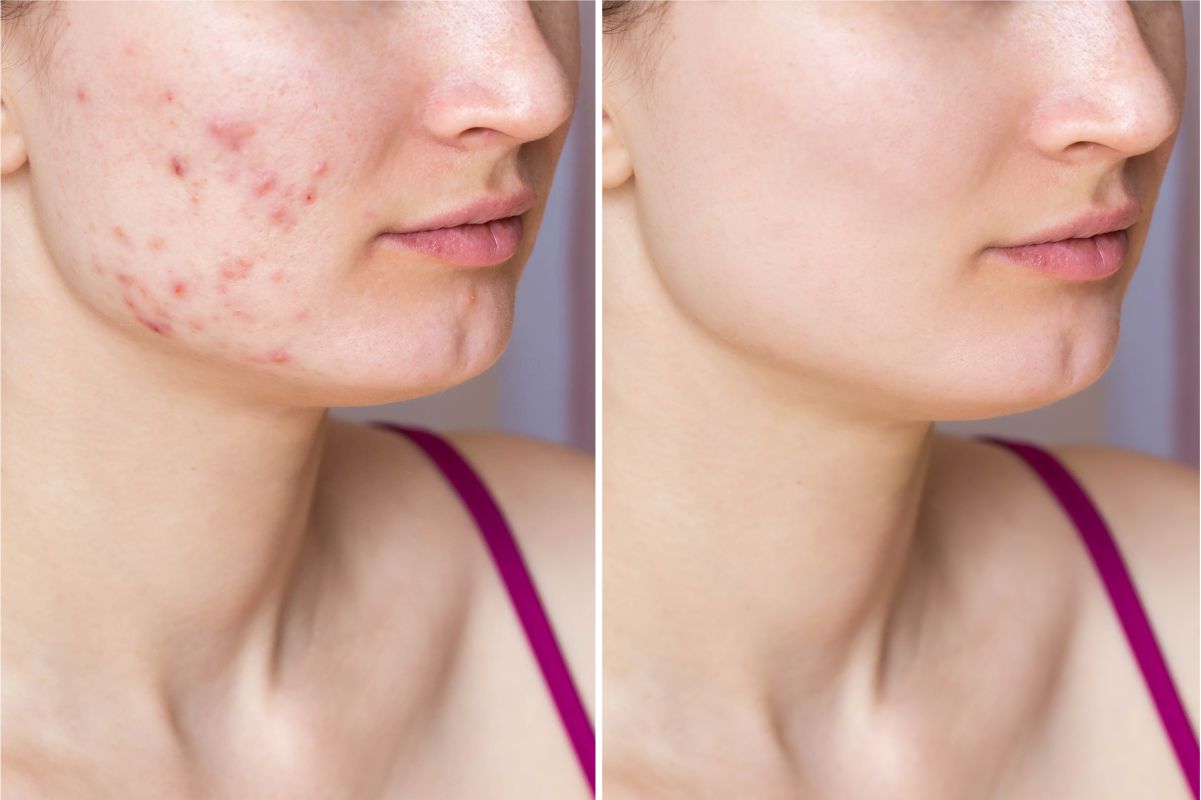 Co2 Laser Resurfacing For Scars