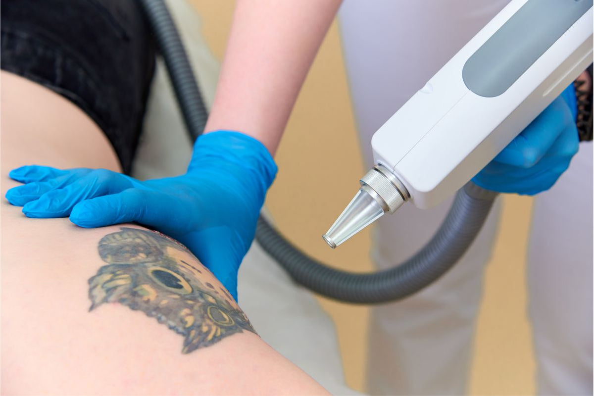 Tattoo Removal-Average Size