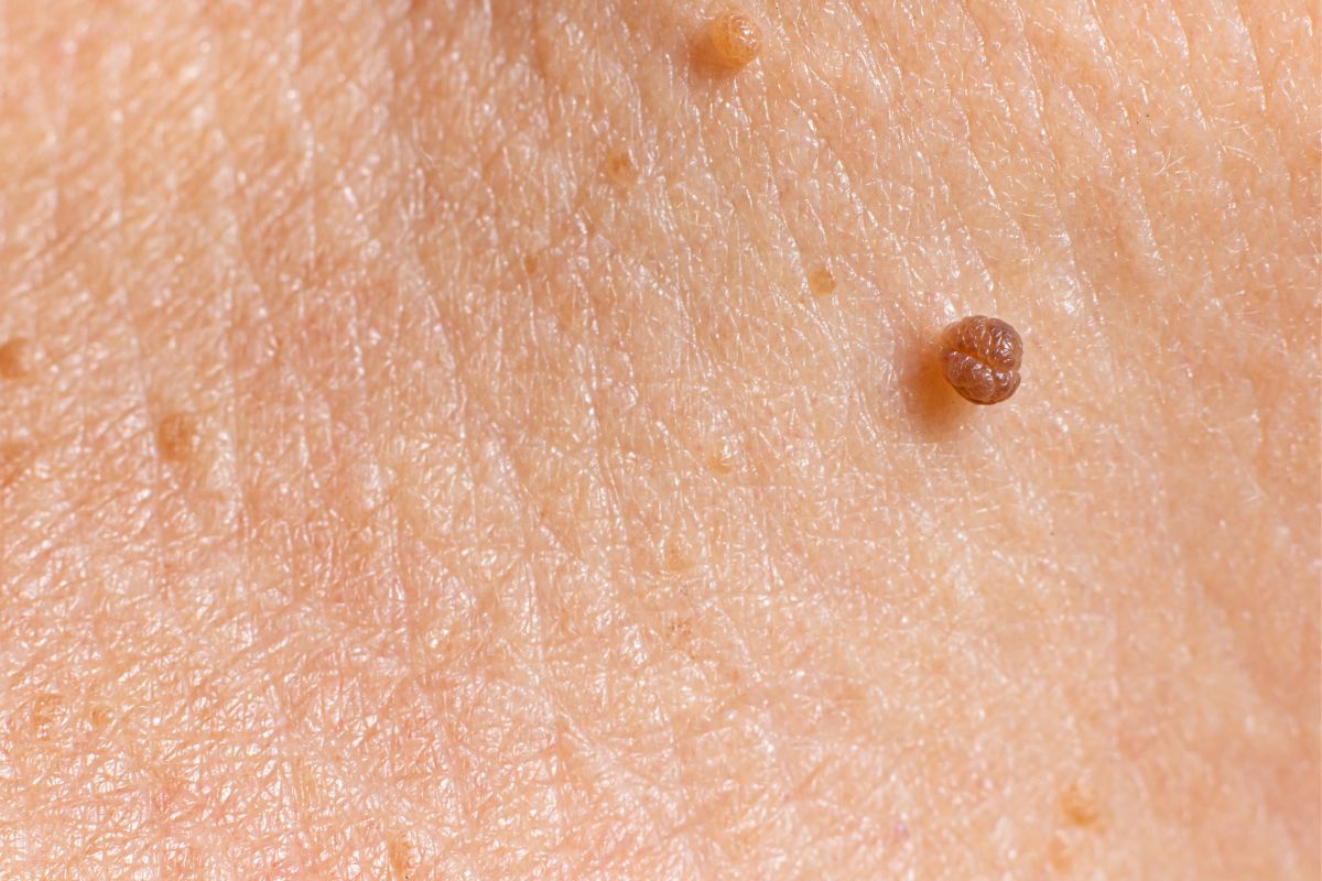 Skin Tags And Other Skin Imperfections Removal-1 Hour Session